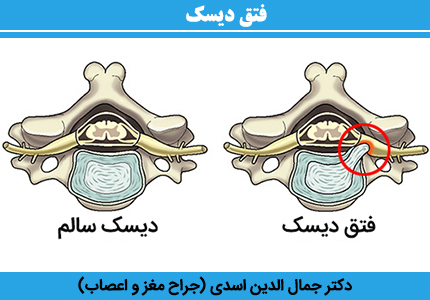 فتق-دیسک