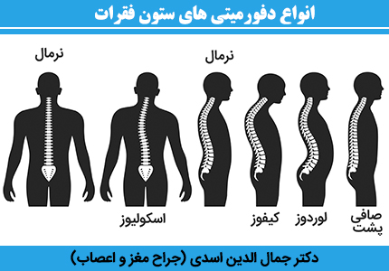 انواع-دفورمیتی-های-ستون-فقرات