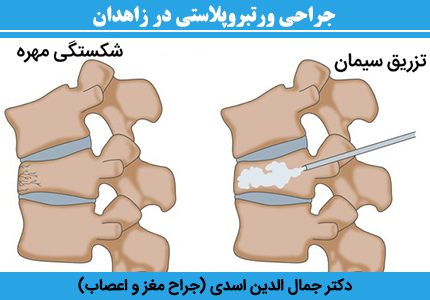 جراحی-ورتبروپلاستی-در-زاهدان