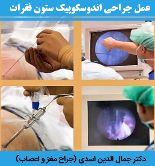 عمل-جراحی-اندوسکوپیک-ستون-فقرات