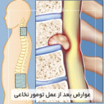 عوارض-بعد-از-عمل-تومور-نخاعی