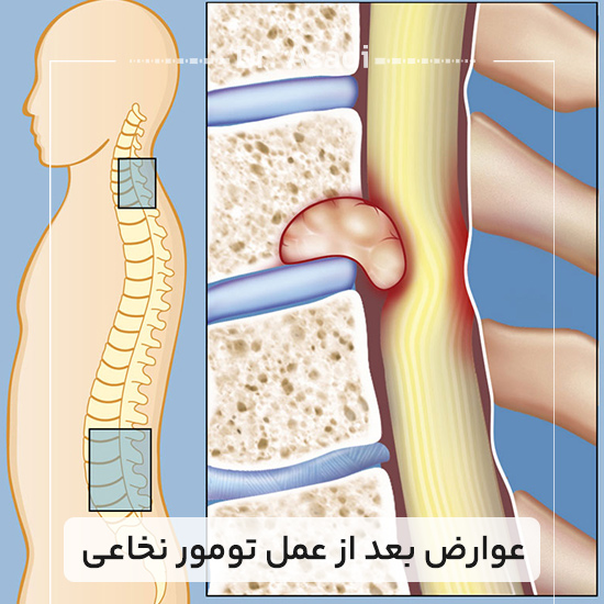عوارض-بعد-از-عمل-تومور-نخاعی