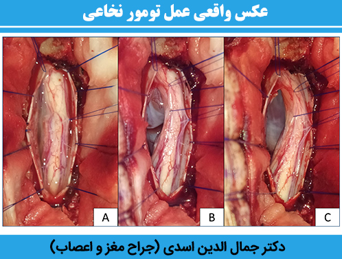 عکس-واقعی-عمل-تومور-نخاعی