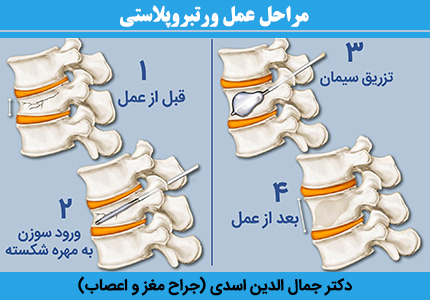 مراحل-عمل-ورتبروپلاستی