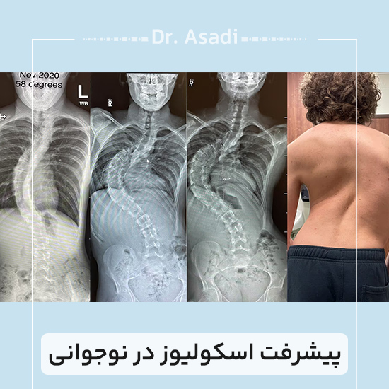 پیشرفت-اسکولیوز-در-نوجوانی