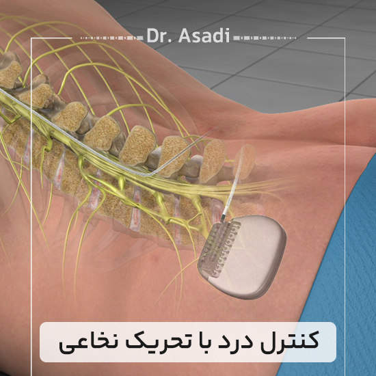 کنترل-درد-با-تحریک-نخاعی