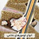 انواع-تومورهای-نخاعی