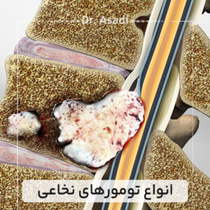انواع-تومورهای-نخاعی