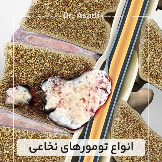 انواع-تومورهای-نخاعی