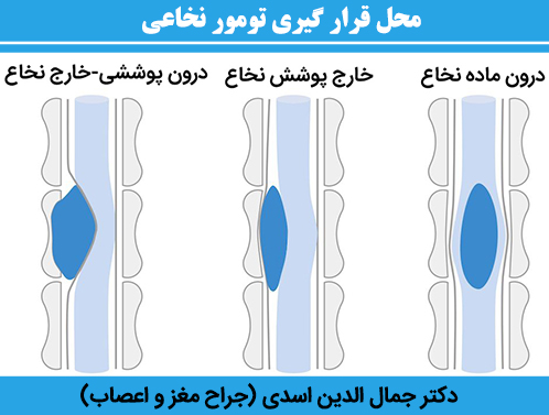 محل-قرار-گیری-تومور-نخاعی