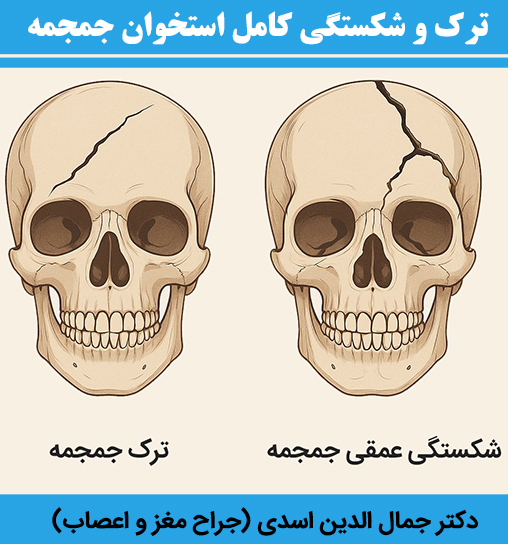 ترک-و-شکستگی-کامل-استخوان-جمجمه