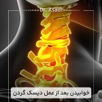 خوابیدن-بعد-از-عمل-دیسک-گردن