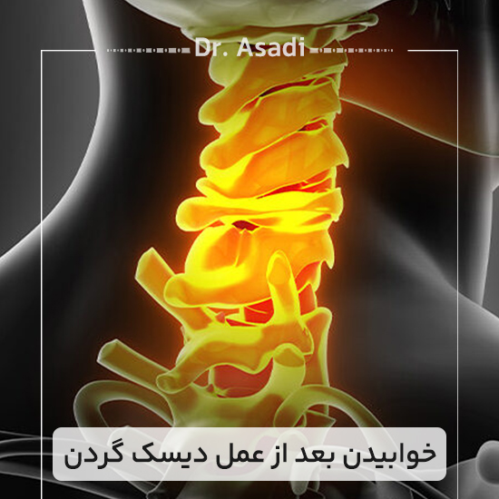 خوابیدن-بعد-از-عمل-دیسک-گردن