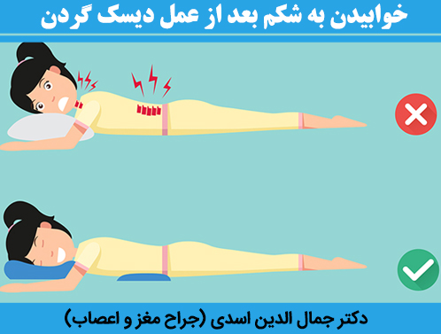 خوابیدن-به-شکم-بعد-از-عمل-دیسک-گردن