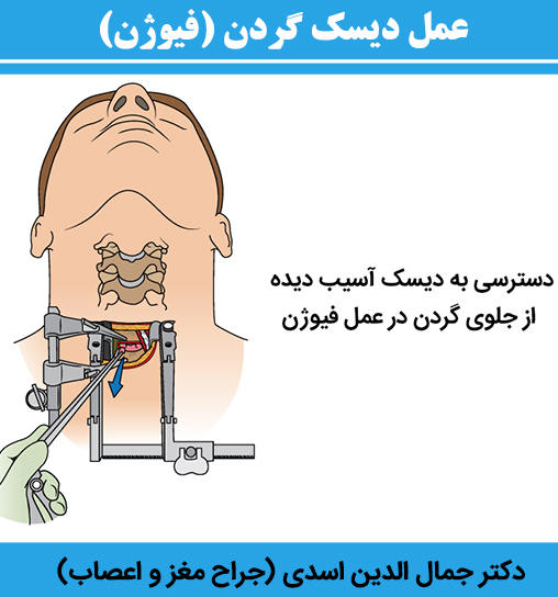 عمل-دیسک-گردن-(فیوژن)