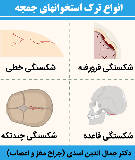 انواع-ترک-استخوانهای-جمجه