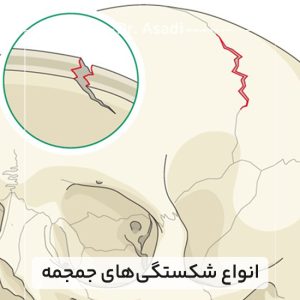 انواع-شکستگی‌های-جمجمه