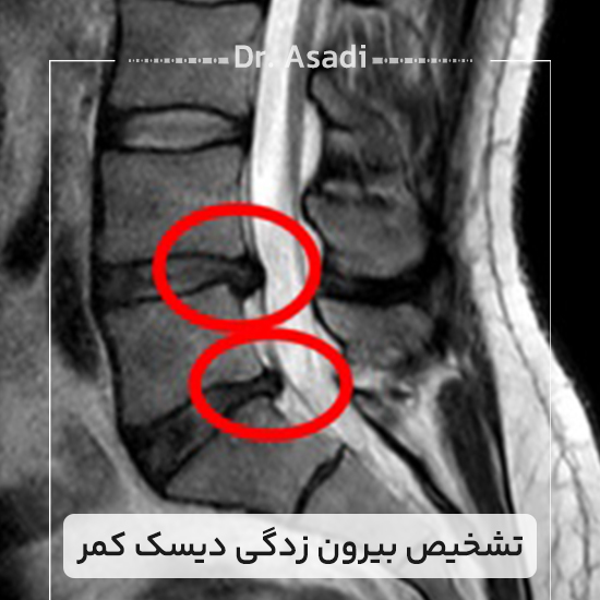 تشخیص-بیرون-زدگی-دیسک-کمر
