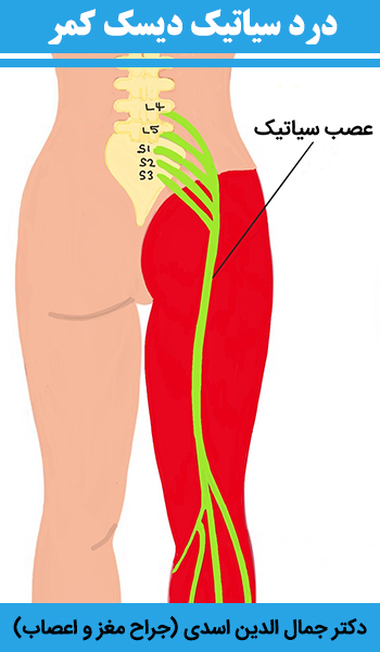 درد-سیاتیک-دیسک-کمر