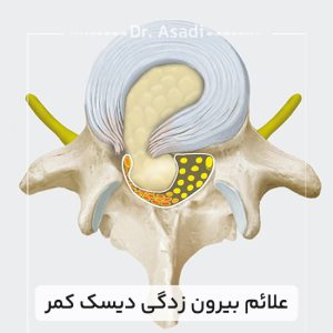 علائم-بیرون-زدگی-دیسک-کمر