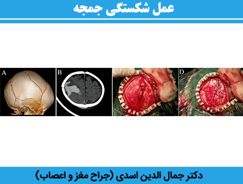 عمل-شکستگی-جمجه