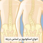 انواع-اسکولیوز-بر-اساس-درجه
