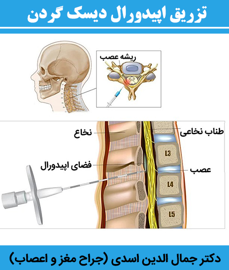 تزریق-اپیدورال-دیسک-گردن