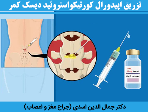 تزریق-اپیدورال-کورتیکواستروئید-دیسک-کمر