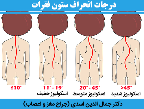 درجات-انحراف-ستون-فقرات