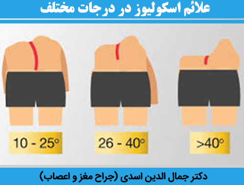 علائم-اسکولیوز-در-درجات-مختلف
