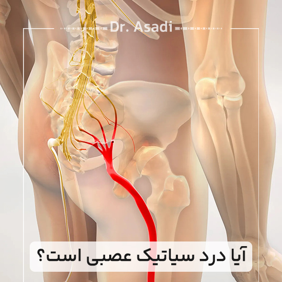 آیا-درد-سیاتیک-عصبی-است