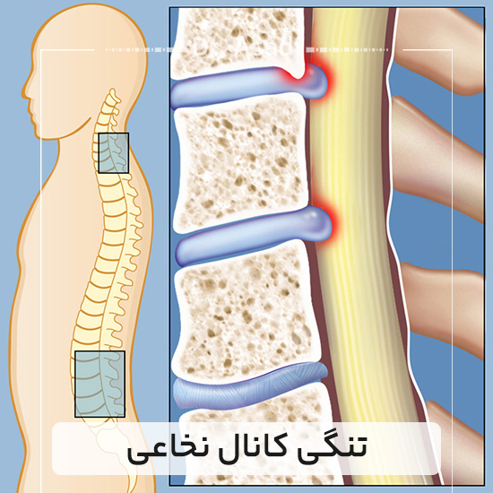 تنگی-کانال-نخاعی