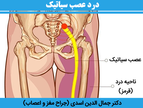 درد-عصب-سیاتیک