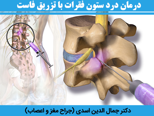 درمان-درد-ستون-فقرات-با-تزریق-فاست-1