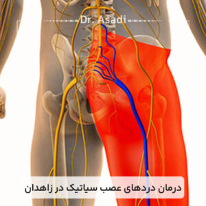 درمان-دردهای-عصب-سیاتیک-در-زاهدان