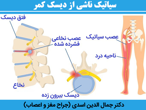 سیاتیک-ناشی-از-دیسک-کمر