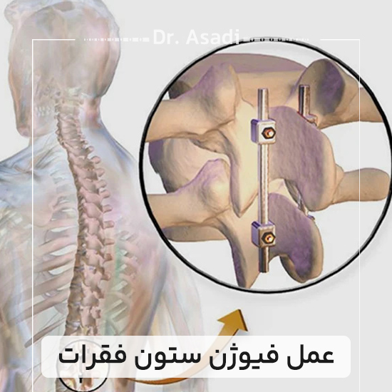 عمل-فیوژن-ستون-فقرات