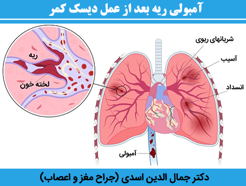 آمبولی-ریه-بعد-از-عمل-دیسک-کمر