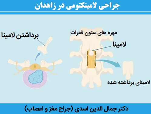 جراحی-لامینکتومی-در-زاهدان