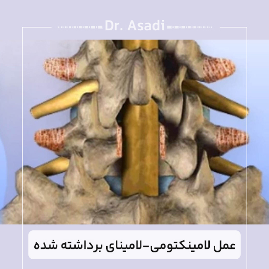 عمل-لامینکتومی-لامینای-برداشته-شده